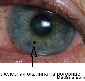 Окалина на глазу
